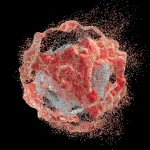 Bowel cancer “melted” after immunotherapy, then stayed away