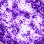 First case of measles confirmed in 2026 in San Luis Obispo County