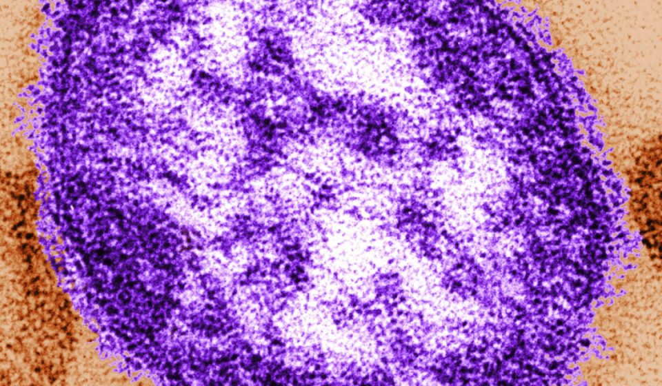 First case of measles confirmed in 2026 in San Luis Obispo County